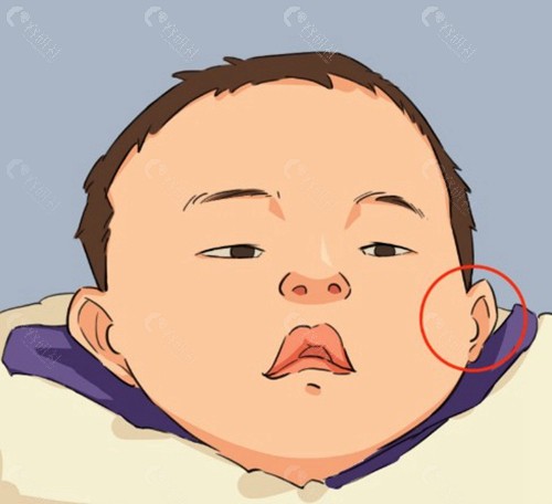 影响耳朵整形手术价格的因素