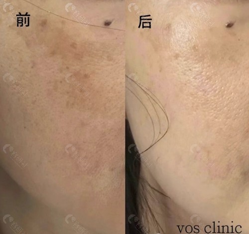 韩国VOS皮肤科治疗黄褐斑前后对比照