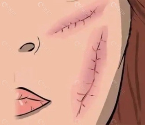 疤痕切除缝合术
