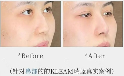 韩国kleam皮肤科医院瑞蓝玻尿酸隆鼻前后对比图