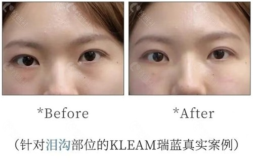 韩国kleam皮肤科医院瑞蓝玻尿酸改善泪沟的图片