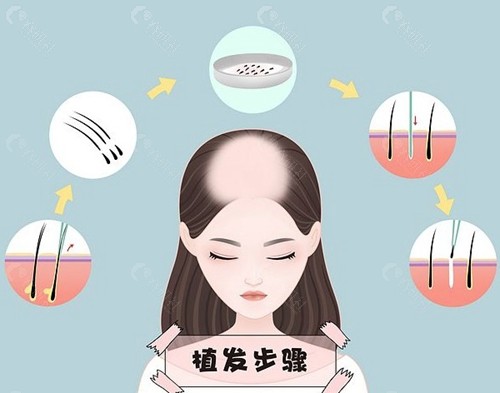雍禾植发医院实力