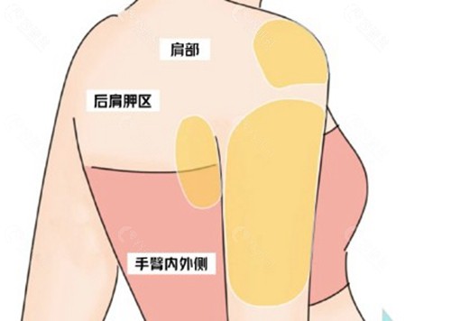为啥同样做手臂吸脂价格不一样？
