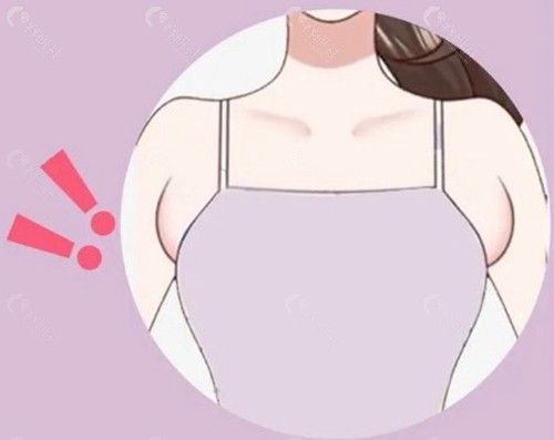 切除法去副乳