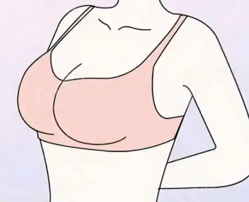 乳房缩小手术垂直切口好还是倒“T”形切口好