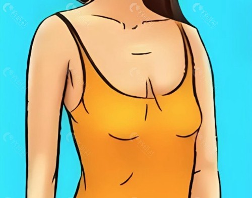 乳房缩小手术一般可以缩小几个罩杯呢？