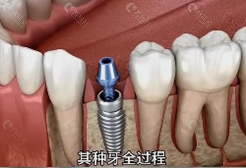 镇江牙管家口腔种植牙好吗