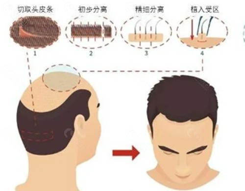 宜昌中爱植发好吗