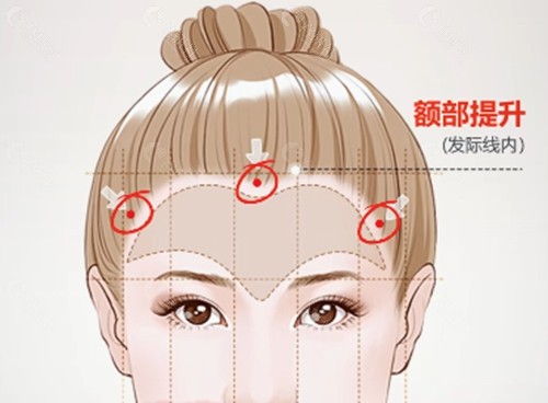 额头拉皮手术维持时间