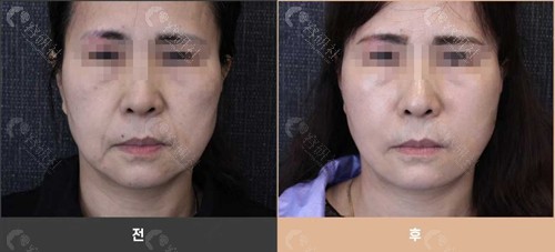韩国bom maru皮肤科馒化脸修复前后对比照