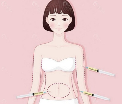 抽脂塑身衣紧穿还是松穿？