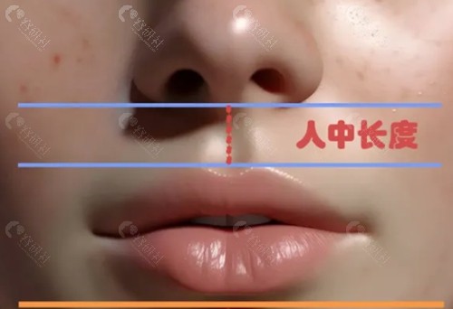 武汉诗美尔做人中缩短好吗