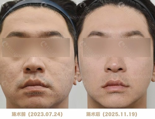 韩国本杰明皮肤科光电提升+痘坑定制化改善方案前后对比照