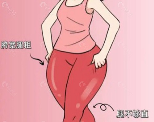 梨形身材抽脂需抽哪些部位？
