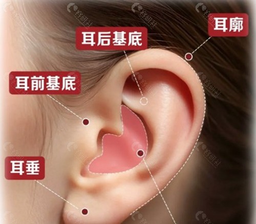 耳基底提升所需玻尿酸的支数