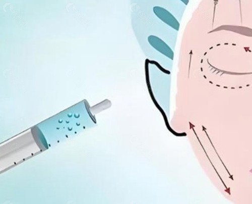 适合耳基底提升的玻尿酸品牌有哪些？