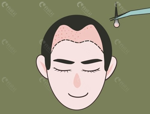 王晓松：微针技术的精细派