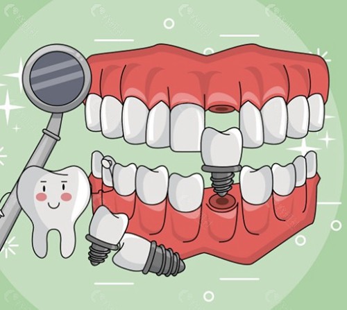影响国产种植牙价格的因素