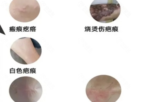 郴州现代女子医院祛疤痕 好吗