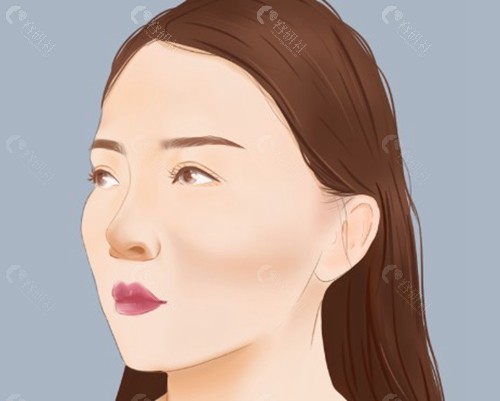 常见的颧骨颧弓矫正手术方法及技术特色