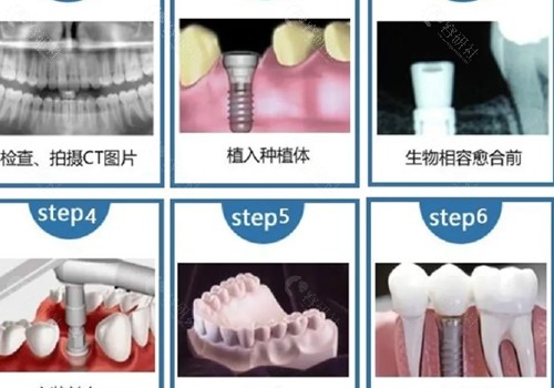 宜春牙卫士口腔种植牙怎么样