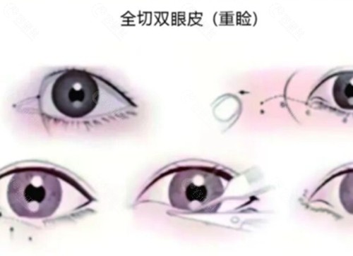 孟祥重做双眼皮手术好吗