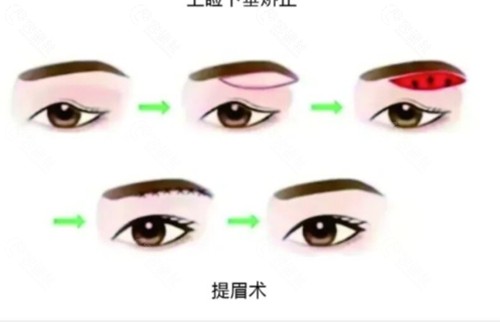 张学雷做双眼皮手术怎么样