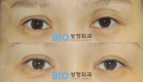 韩国BIO整形外科医院曹仁昌院长眼修复对比照