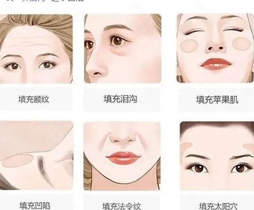 李烈做面部脂肪填充怎么样 李烈做面部脂肪填充怎么样