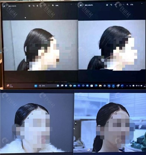 韩国雕刻整形外科医院骨水泥填充前后对比照