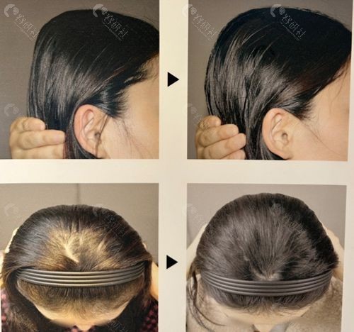 韩国雕刻医院骨水泥填充后脑勺前后对比图