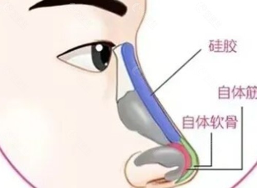 成都八大处隆鼻医生