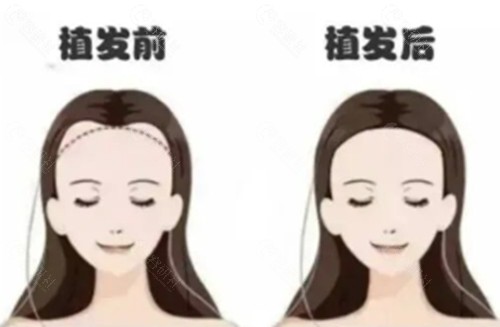 拉萨人民医院植发好吗