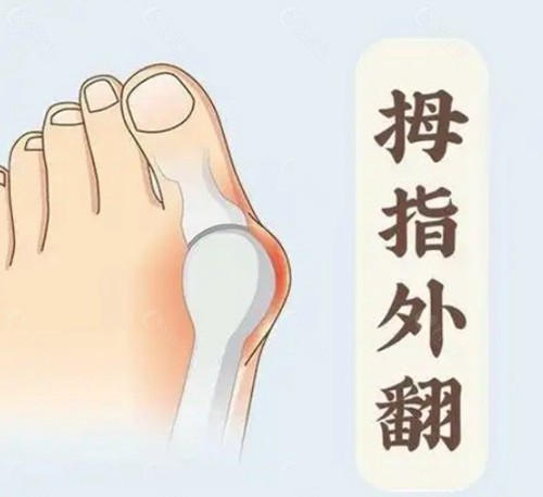  2026 韓國大腳骨整形手術價格參考