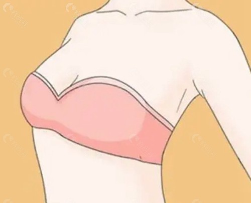 假体隆胸50天手感还是比较硬正常吗？