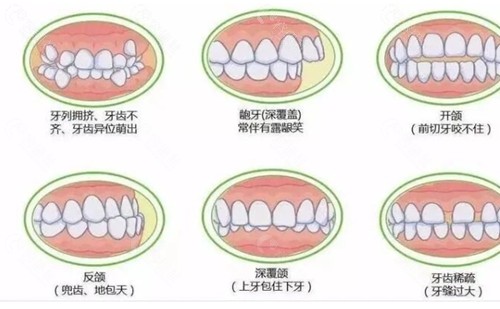 刘窕牙齿矫正技术好吗