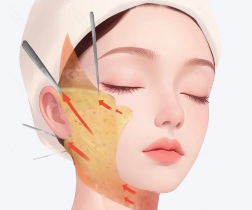 面部提升三件套的价格分析