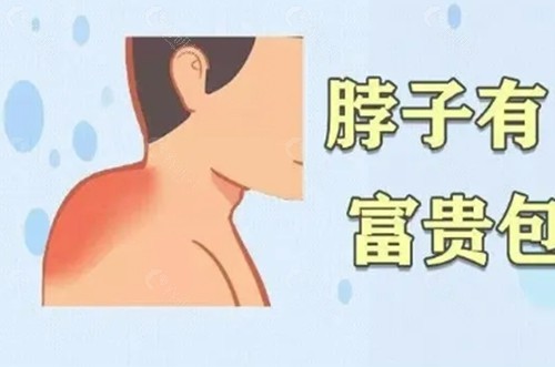 济南韩氏治疗富贵包好吗