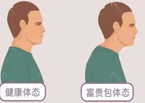 济南诺德做富贵包吸脂好吗