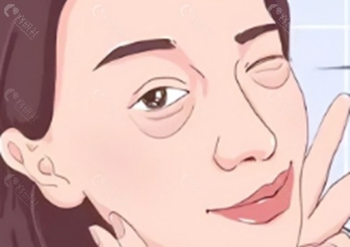 汉中韩美去眼袋好吗