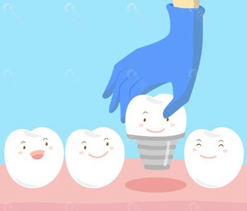 2026 人工植牙費用明細