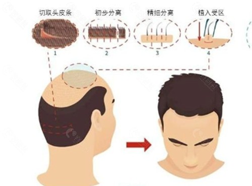 杨志祥植发技术好吗