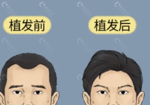 廖骏植发好吗