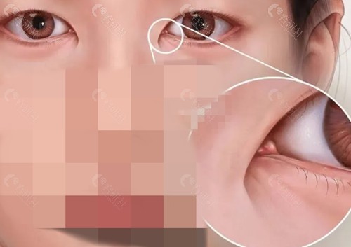 武汉艺星唐龙做双眼皮怎么样