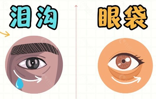 为什么眼袋和泪沟要“一起做”？