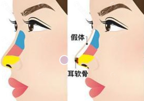 李炳玟隆鼻手术好吗