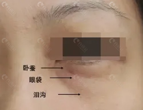 洛阳维多丽亚去眼袋好吗