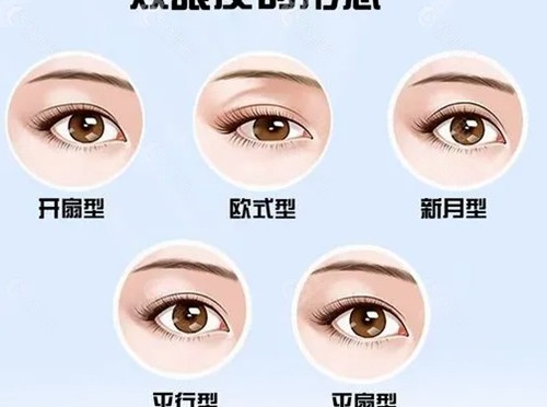 许昌韩后做双眼皮怎么样