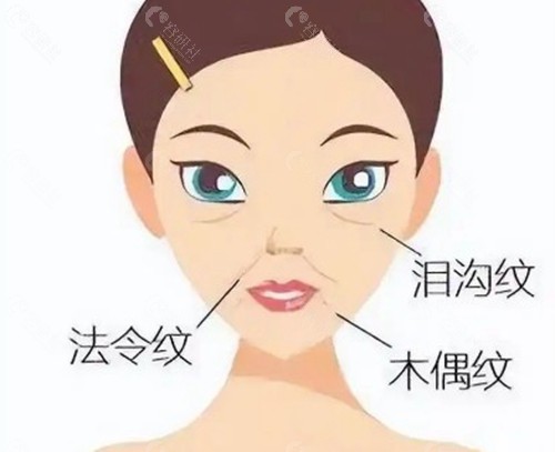 法令纹填充需要几支玻尿酸？