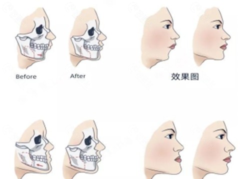 何锦泉正颌手术好吗